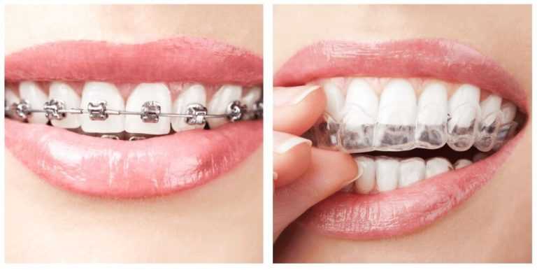 Orthodontic Braces and Aligners